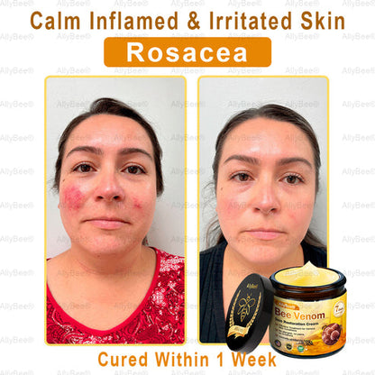 BEE VENOM SKIN CREAM (Copy)